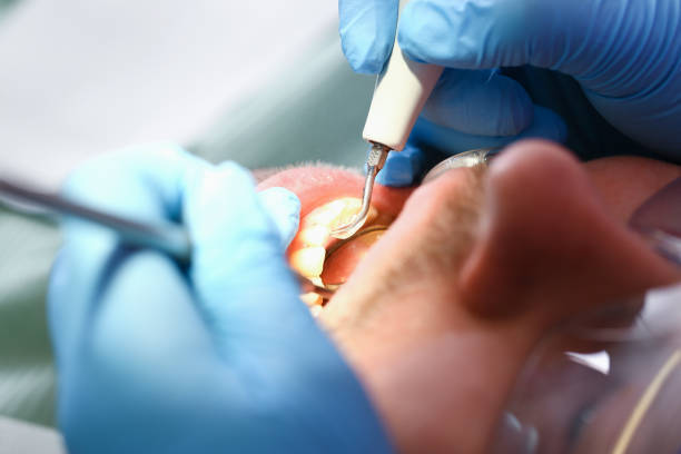Best Emergency Tooth Extraction in Belmont, MS