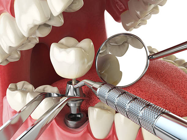 Best Emergency Wisdom Teeth Removal in Belmont, MS